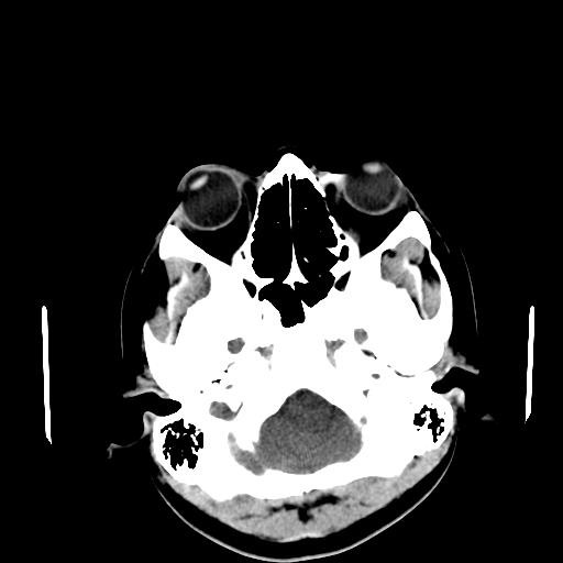 File:Neurofibromatosis type 2 (Radiopaedia 25389-25637 Axial non-contrast 3).jpg
