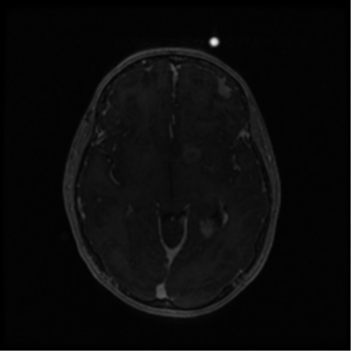 Neurofibromatosis type 2 (Radiopaedia 45229-49244 Axial T1 C+ 60).png
