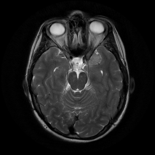 File:Neurofibromatosis type 2 (Radiopaedia 45229-49244 Axial T2 7).png
