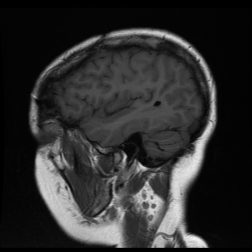 File:Neurofibromatosis type 2 (Radiopaedia 45229-49251 Sagittal T1 4).png