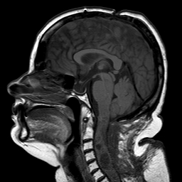 File:Neurofibromatosis type 2 (Radiopaedia 8713-9518 Sagittal T1 10).jpg