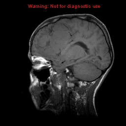 File:Neurofibromatosis type 2 (Radiopaedia 8953-9730 Sagittal T1 8).jpg
