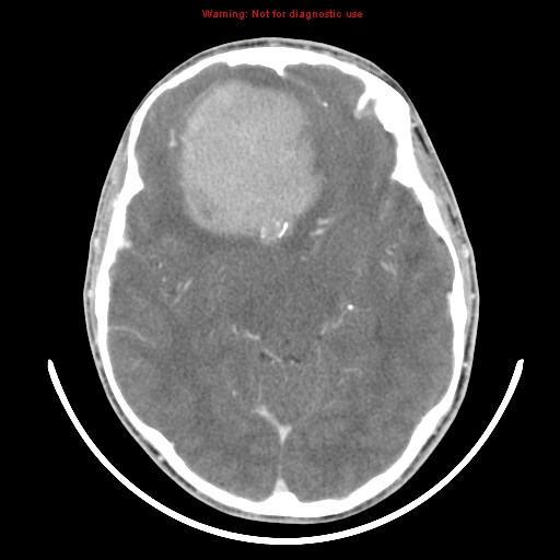 File:Neurofibromatosis type 2 (Radiopaedia 8953-9732 C 16).jpg
