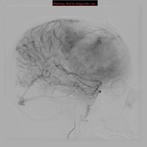 File:Neurofibromatosis type 2 (Radiopaedia 8953-9733 B 7).jpg