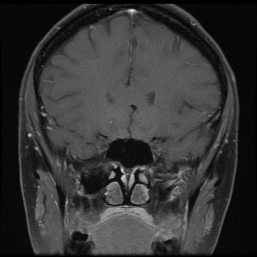 File:Neurofibromatosis type 2 - bilateral acoustic neuromata (Radiopaedia 40060-42566 Coronal T1 C+ 14).png