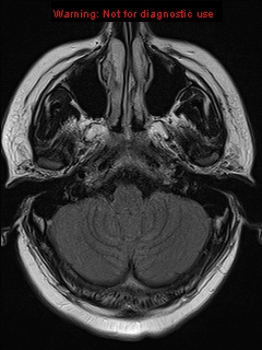 File:Neuroglial cyst (Radiopaedia 10713-11184 Axial FLAIR 19).jpg