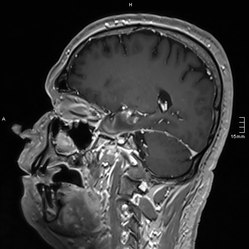 Neurosarcoidosis - involvement of the mesial temporal lobes (Radiopaedia 67429-76820 Sagittal T1 C+ 64).jpg