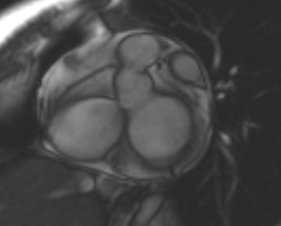 File:Non-compaction of the left ventricle (Radiopaedia 69436-79314 Short axis cine 215).jpg