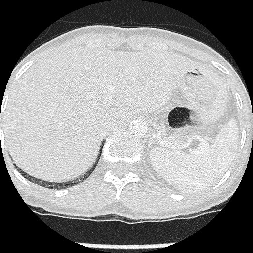 File:Non-small cell lung cancer with miliary metastases (Radiopaedia 23995-24193 Axial lung window 23).jpg