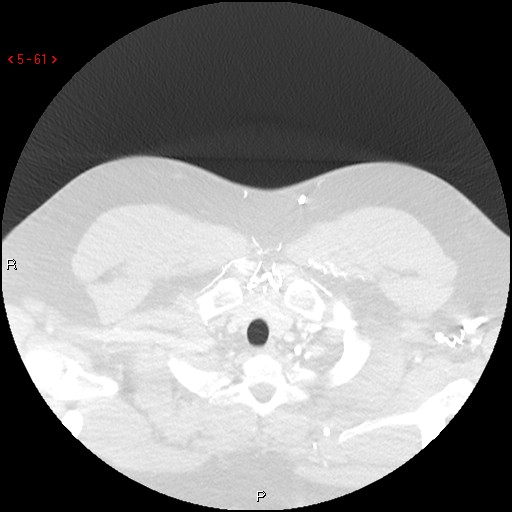 File:Non-specific interstitial pneumonitis (Radiopaedia 27044-27222 Axial lung window 52).jpg