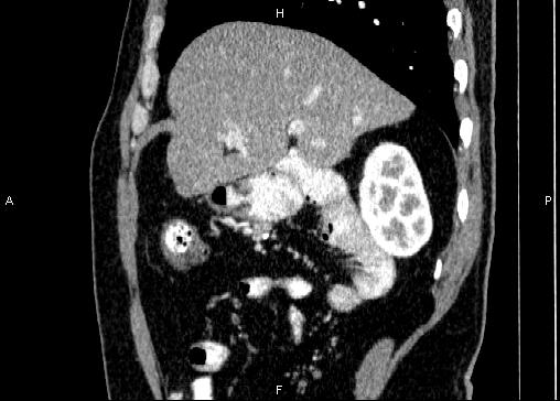 Non-syndromic pancreatic endocrine tumor (Radiopaedia 86958-103178 E 29).jpg