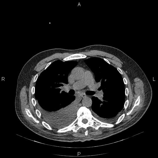 File:Non Hodgkin lymphoma in a patient with ankylosing spondylitis (Radiopaedia 84323-99624 Axial non-contrast 16).jpg
