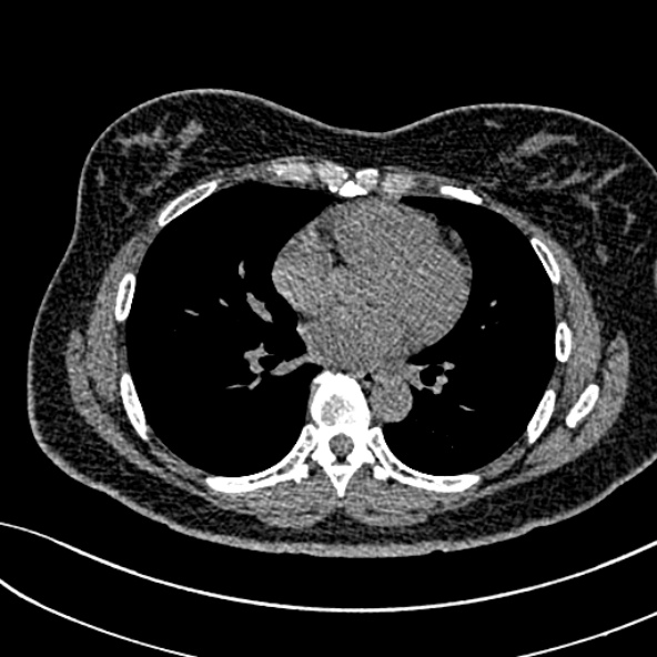 Normal CT chest- adult female (Radiopaedia 52522-58428 Axial non-contrast 74).jpg