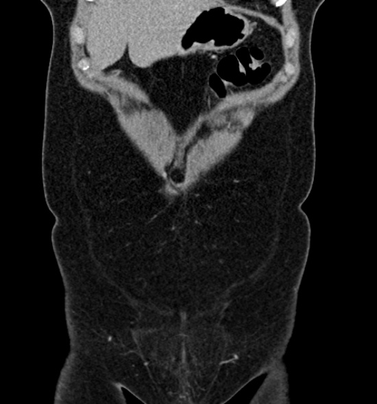 File:Normal CT intravenous urogram (Radiopaedia 39444-41759 A 178).jpg