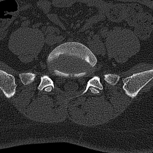 File:Normal CT lumbar spine (Radiopaedia 53981-60118 Axial bone window 63).jpg