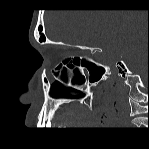 Normal CT paranasal sinuses (Radiopaedia 42286-45390 Sagittal bone window 36).jpg