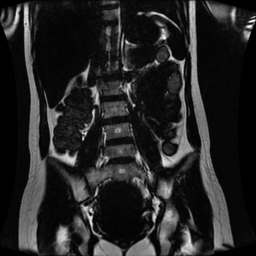 Normal MRI abdomen in pregnancy (Radiopaedia 88001-104541 N 85).jpg