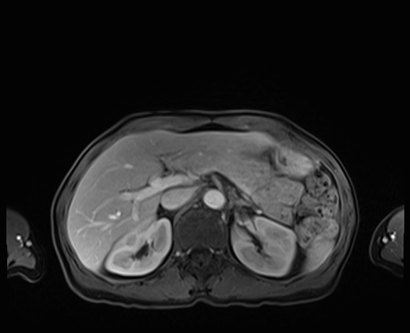 Normal adrenal glands MRI (Radiopaedia 82017-96004 K 29).jpg