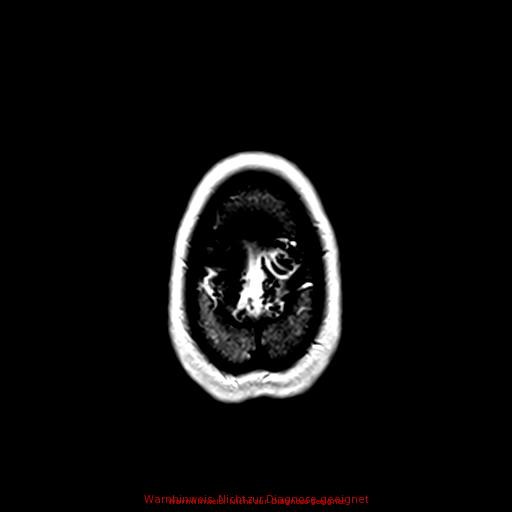 Normal adult brain MRI (non-enhanced and contrast-enhanced) (Radiopaedia 75262-86379 Axial T1 C+ 171).jpg