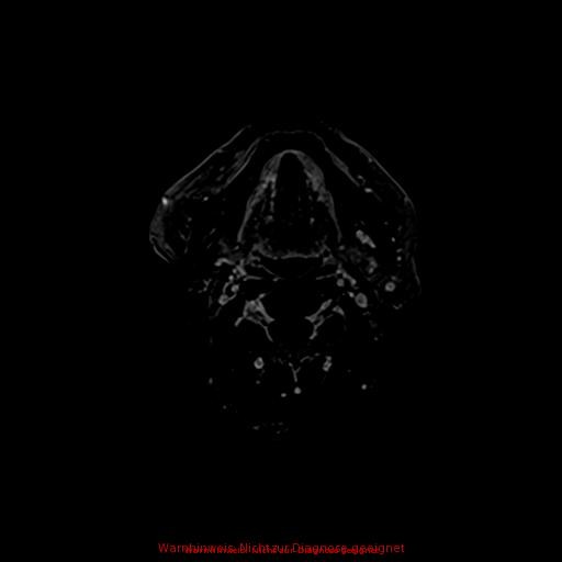 Normal adult brain MRI (non-enhanced and contrast-enhanced) (Radiopaedia 75262-86379 Axial T1 C+ 4).jpg