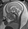Normal brain fetal MRI - 22 weeks (Radiopaedia 50623-56050 Sagittal T2 Haste 12).jpg