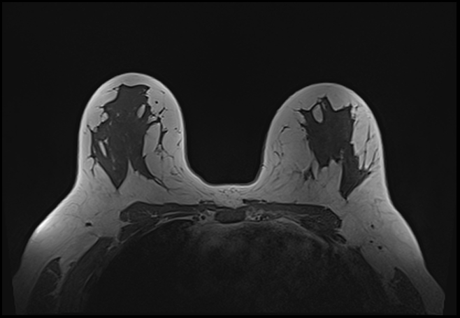 File:Normal breast MRI - dense breasts (Radiopaedia 80454-93850 Axial T1 132).jpg