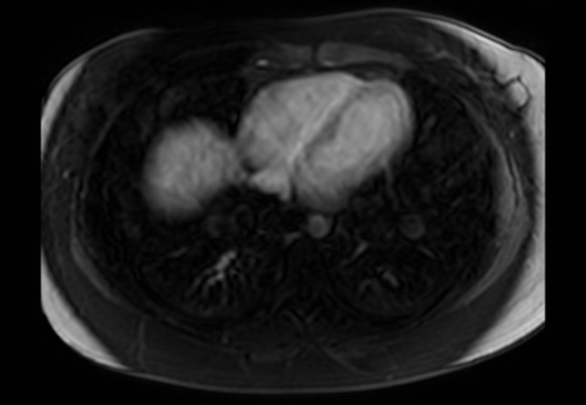 Normal liver MRI with Gadolinium (Radiopaedia 58913-66163 J 75).jpg