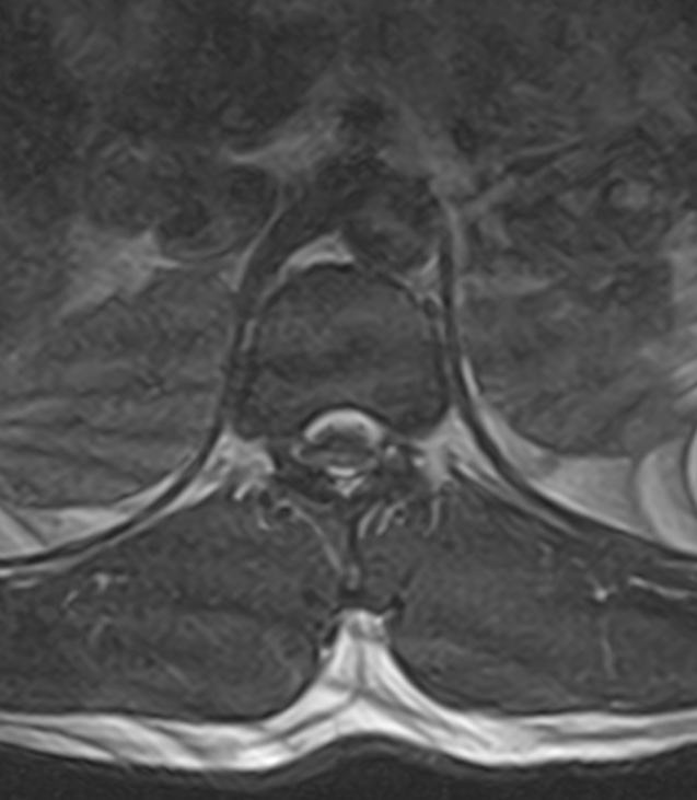 Normal lumbar spine MRI - low-field MRI scanner (Radiopaedia 40976-43699 Axial T2 8).jpg