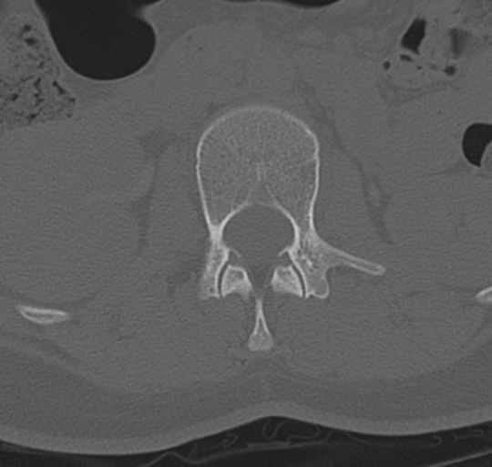 File:Normal lumbosacral CT (Radiopaedia 37923-39867 Axial bone window 39).png
