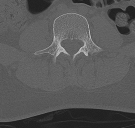 File:Normal lumbosacral CT (Radiopaedia 37923-39867 Axial bone window 62).png