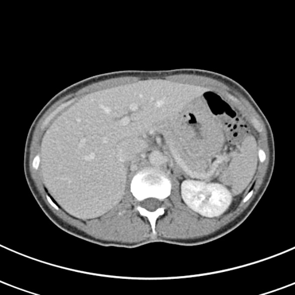 File:Normal multiphase CT liver (Radiopaedia 38026-39996 C 20).jpg