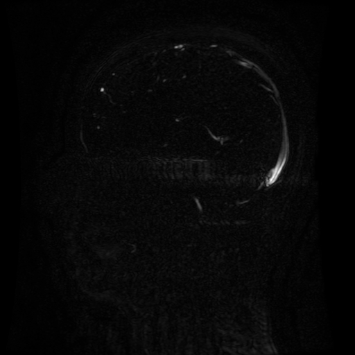 Normal noncontrast MR venography (Radiopaedia 87578-103957 A 92).jpg
