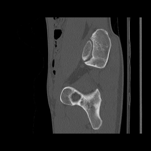Normal pelvis (Radiopaedia 51473-57238 Sagittal bone window 48).jpg