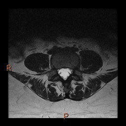 File:Normal spine MRI (Radiopaedia 77323-89408 Axial T2 17).jpg