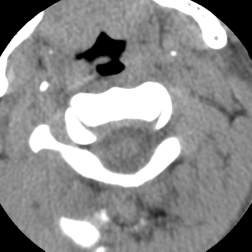 Normal trauma cervical spine (Radiopaedia 41017-43760 Axial non-contrast 16).png