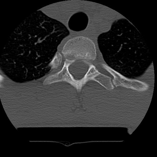 Normal trauma spine imaging (age 16) (Radiopaedia 45335-49358 Axial bone window 86).jpg