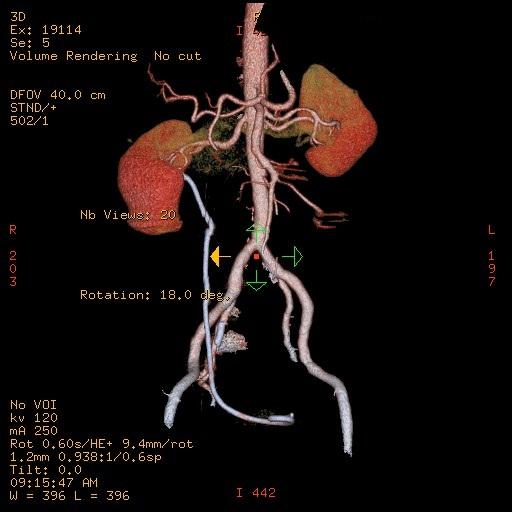 File:Obstructed kidney with perinephric urinoma (Radiopaedia 26889-27067 3D reconstruction 1).jpg