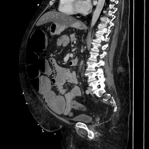 Obstructive colonic diverticular stricture (Radiopaedia 81085-94675 C 135).jpg