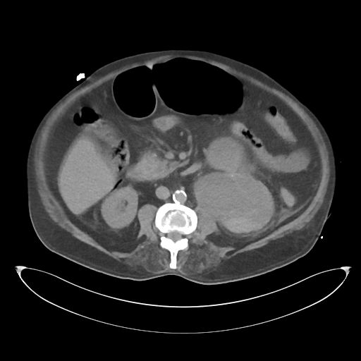 File:Obstructive pyelonephritis (Radiopaedia 46411-50844 Axial non-contrast 38).png