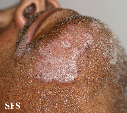 File:Psoriasis (Dermatology Atlas 43).jpg