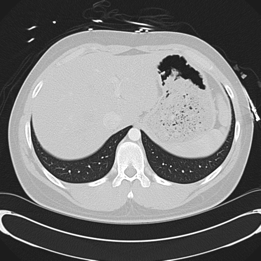 'Bovine' aortic arch (Radiopaedia 33554-34637 Axial lung window 57).png