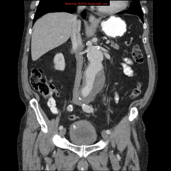 File:Abdominal aortic aneurysm (Radiopaedia 10122-10660 Coronal C+ portal venous phase 22).jpg