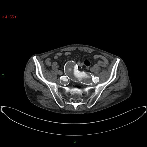 File:Abdominal aortic aneurysm (Radiopaedia 16155-15834 Axial C+ arterial phase 35).jpg