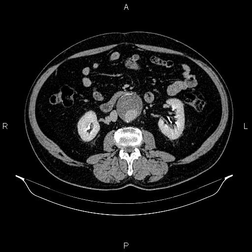 Abdominal aortic aneurysm (Radiopaedia 83094-97462 Axial renal excretory phase 51).jpg
