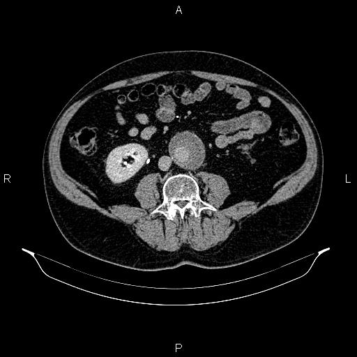 File:Abdominal aortic aneurysm (Radiopaedia 83094-97462 Axial renal excretory phase 63).jpg