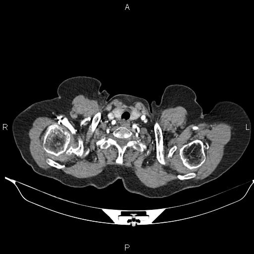 File:Abdominal aortic aneurysm (Radiopaedia 85063-100606 Axial C+ arterial phase 4).jpg