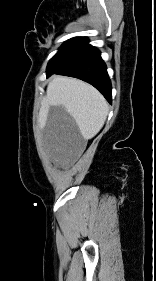 Abdominal lymphoma - with sandwich sign (Radiopaedia 53486-59492 Sagittal C+ portal venous phase 28).jpg