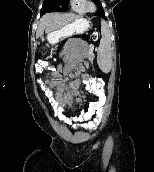Abdominal lymphoma with sandwich sign (Radiopaedia 84378-99704 Coronal C+ portal venous phase 9).jpg