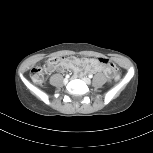 File:Abdominal multi-trauma - devascularised kidney and liver, spleen and pancreatic lacerations (Radiopaedia 34984-36486 Axial C+ portal venous phase 56).png