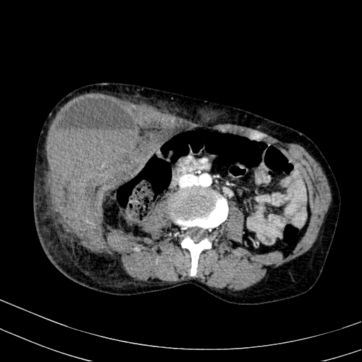 Abdominal wall hematoma with active bleeding (Radiopaedia 83915-99117 Axial renal cortical phase 49).jpg
